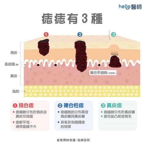 為什麼身上會有痣|痣形成的原因？痣長毛、痣變多變大是痣病變？5招判。